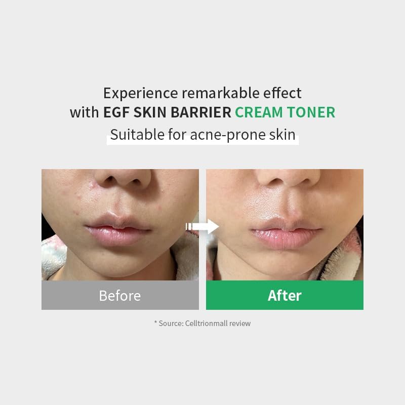 Zipiderm EGF Skin Barrier Repair Set - Cream Toner+Ampoule+Cream - Image 2